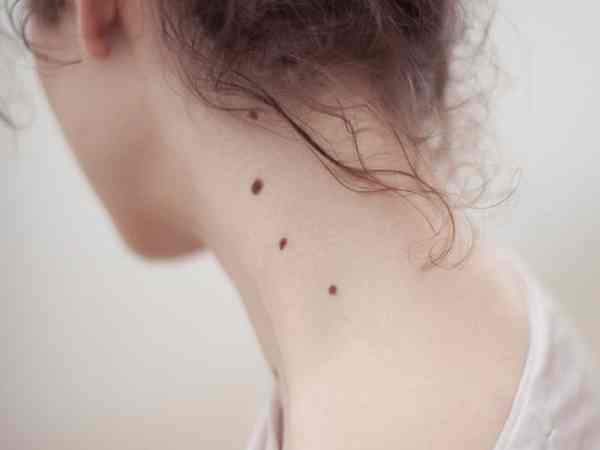 nốt ruồi ở cổ nữ