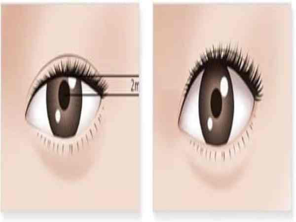 Tướng mắt lờ đờ là gì? mắt lờ đờ