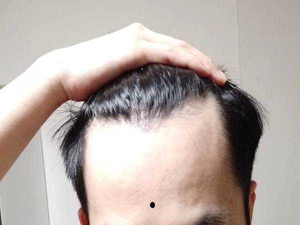 Nốt ruồi ở giữa trán nam: Vị trí của tư duy lãnh đạo  Nốt ruồi ở giữa trán nam: Vị trí của tư duy lãnh đạo