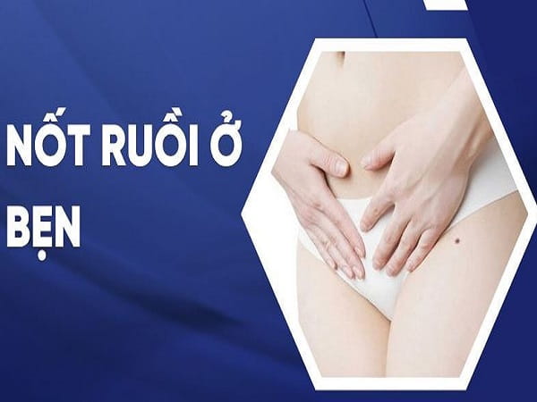 Ý nghĩa nhân tướng mụn ruồi ở bẹn